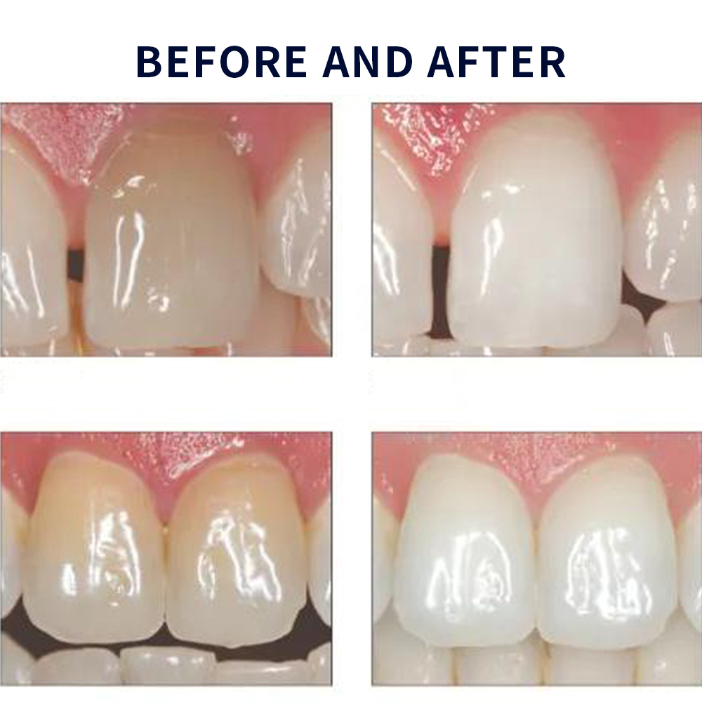 Opalescence Whitening 20% PF 2 - огляд і ціна Teeth Whitening At Home Kit