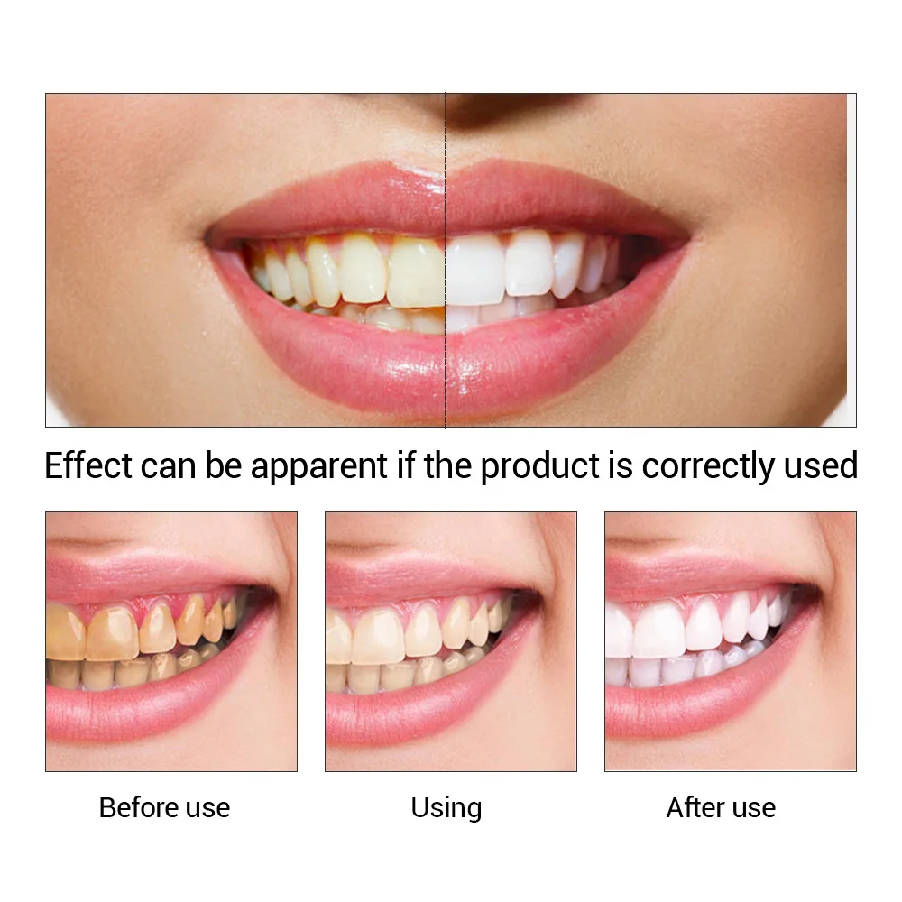 FTEENPLY Teeth Whitening Essen - огляд і ціна Teeth Whitening Co